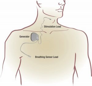 Inspire Sleep Apnea Therapy Diagram