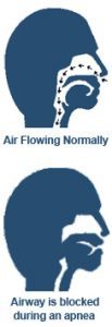 Normal Airflow and Airflow During an Apnea