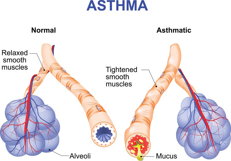 Image result for Asthma